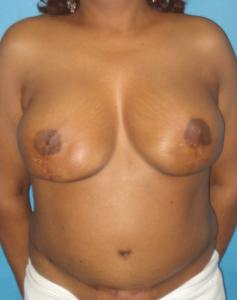 Patient after breast reconstruction using TRAM 